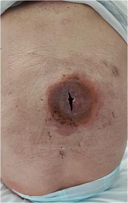 Hybrid endovascular and surgical staged approach for mycotic carotid pseudoaneurysms: a case report and literature review